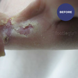 Footlogix Peeling Skin Formula 125ml