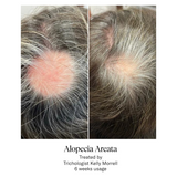 Calecim Advanced Hair System Kit